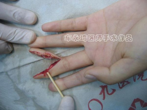 梦到别人手指断了_是什么意思