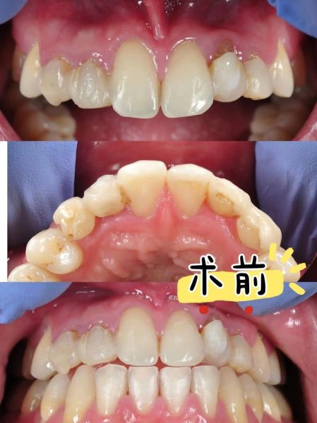 门牙裂缝影响财运吗_门牙裂缝怎么破解