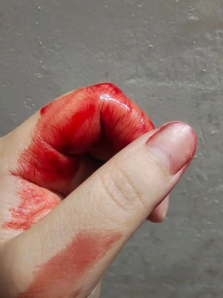 梦到手受伤_意味着什么