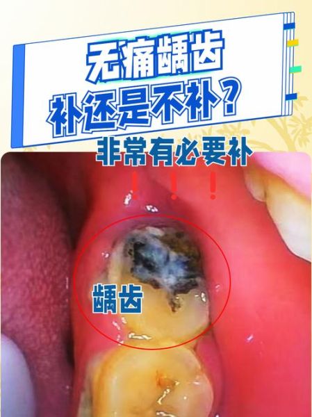 梦到牙齿蛀牙_梦见牙齿坏了是什么意思