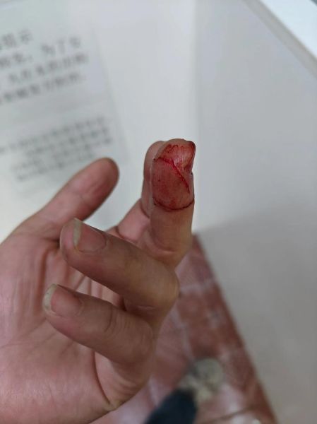 梦到脚受伤流血_是什么预兆