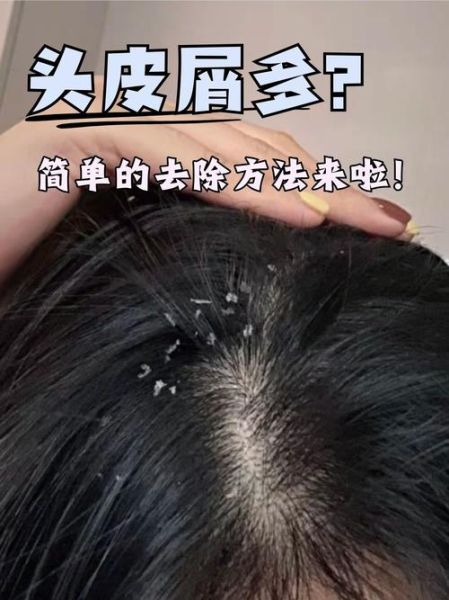 梦到掉头皮屑是什么意思_梦见头皮屑很多怎么办
