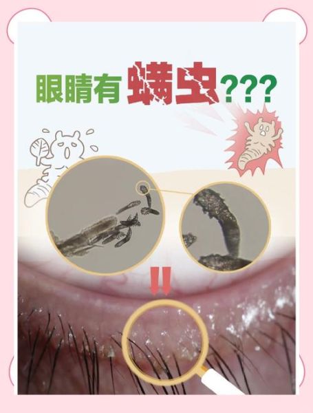 梦到眼睛里长虫子_梦见眼睛有虫子预示什么