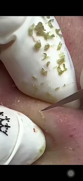 梦到脸上挤出虫子_是什么意思