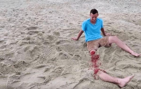 梦到腿断是什么意思_梦到腿断预示什么