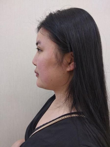 隆鼻改变运势是真的吗_隆鼻后运气会变好吗