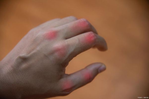 梦到手背受伤_意味着什么
