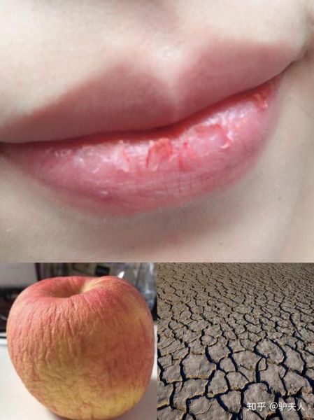 嘴唇干裂是运势差吗_嘴唇颜色看运势准吗