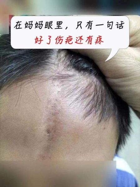眉心有伤疤影响运势吗_如何化解疤痕带来的风水隐患