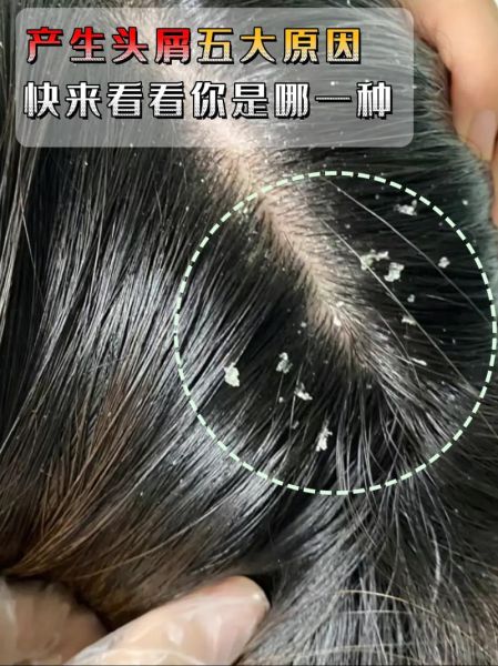 梦到头皮屑_头皮屑很多代表什么