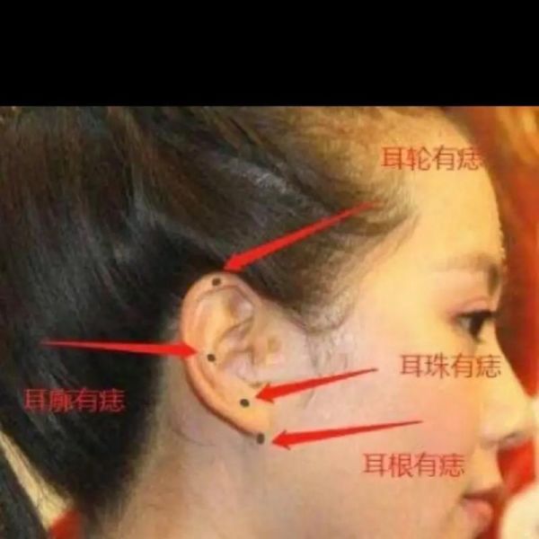 耳垂有痣代表什么_耳垂痣最旺财运是真的吗